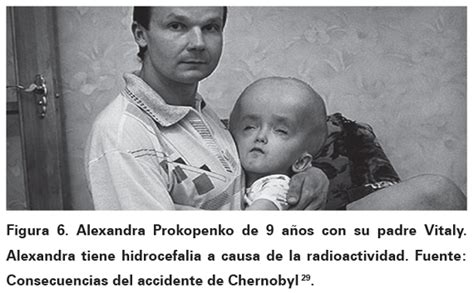 Efectos de Chernobyl Consecuencias a largo plazo de la