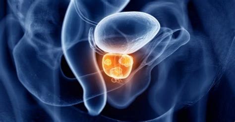 El 12% de los pacientes con cáncer de próstata tratados con ...