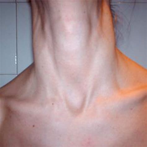 El 4% de los españoles desarrolla nódulos en la tiroides de los que ...