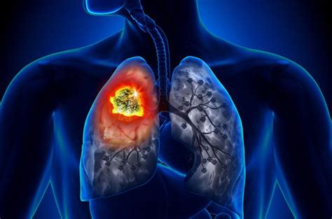 El 45% de los pacientes con cáncer de pulmón nunca ha ...