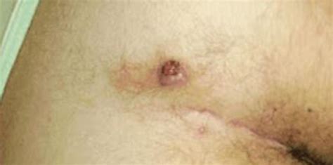 El absceso pilonidal: Conoce sobre esa rara enfermedad ...
