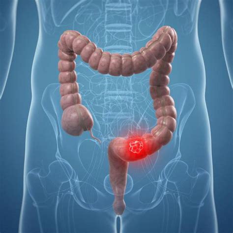 El adenocarcinoma de colon sigmoide: causas, síntomas ...