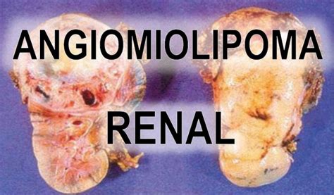 El angiomiolipoma renal, el tumor benigno del que ha sido intervenida ...