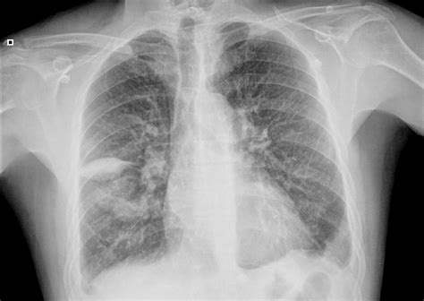 El Blog de Isa y Juan: Tumor fantasma pulmonar