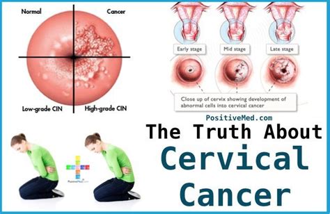 El cáncer cervical   detección y prevención • Conexion Florida