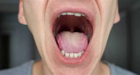 El cáncer de boca es el más usual de los tumores de cabeza – Punto Medio