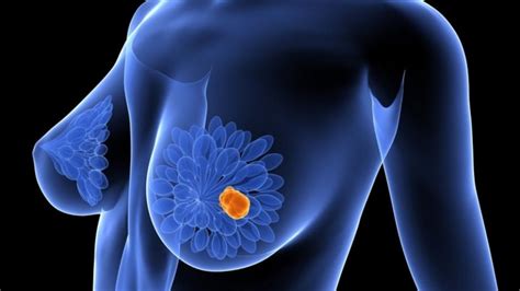 El cáncer de mama engloba a diez tumores distintos, según ...
