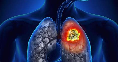 El cáncer del pulmón se cobra tres vidas por minuto ...