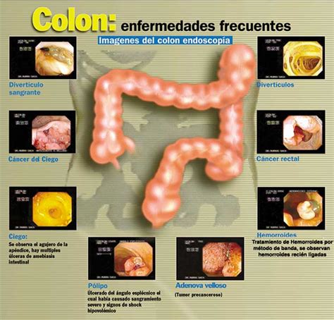 El Colon   Notas Sobre Gastroenterología Cibernética ...