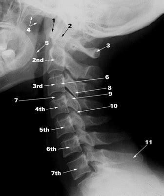El Cuerpo Humano: La séptima vértebra cervical