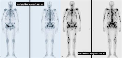 El esfenoides: Metástasis óseas [próstata]. 2 imágenes 1 caso.