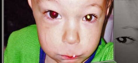 El flash del móvil puede detectar cáncer en el ojo de tu hijo y ...