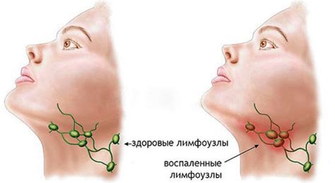 El ganglio linfático debajo de la mandíbula está inflamado: las causas ...