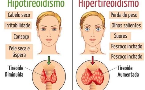 El hipotiroidismo se produce cuando la glándula tiroides ...