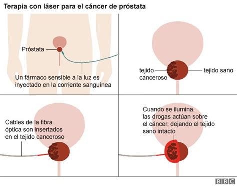 El innovador tratamiento contra el cáncer de próstata que ...