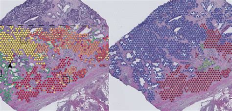 El mapeo genético de los tumores revela cómo crecen los cánceres