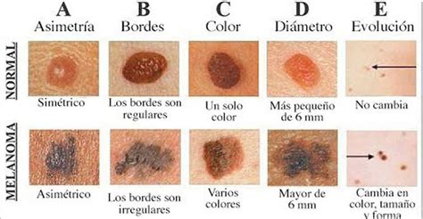 El melanoma, el cáncer de la piel más peligroso ...