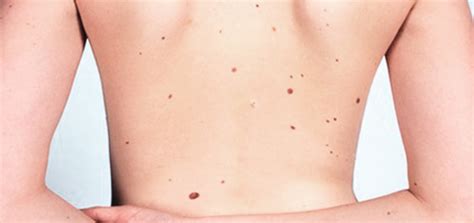 El melanoma, el cáncer de piel más peligroso | Clínica ...