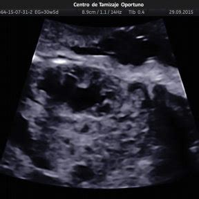El papel del ultrasonido fetal en el diagnóstico de las malformaciones ...