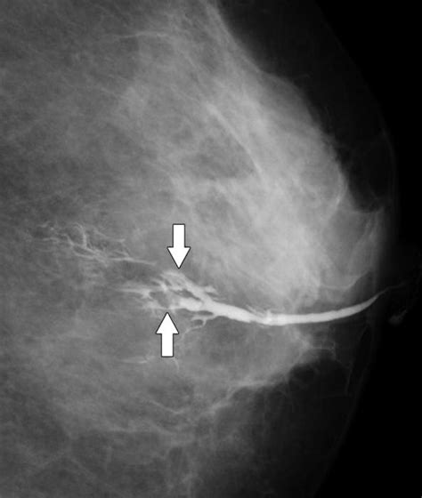 El papiloma intraductal: causas, síntomas, tratamiento