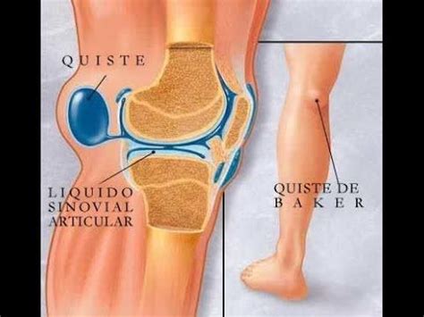 El Quiste de Baker o Quiste Poplíteo  rodilla  | Fisioterapia y Terapia ...