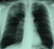El Sistema Respiratorio Humano: Enfermedades del Sistema ...