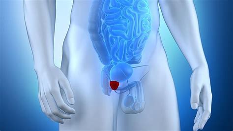 El sobrediagnóstico de cáncer de próstata alcanza el 75% ...