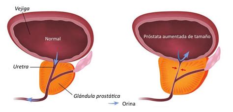 Embolización prostática | Dr. Esteban