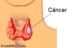 Enciclopedia Salud: Definición de Cáncer de tiroides
