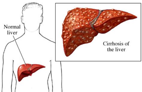 End Stage Cirrhosis | New Health Guide