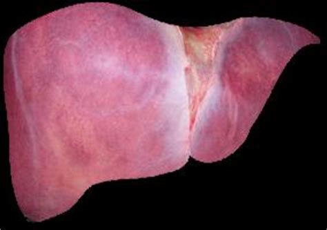 End stage of metastatic liver cancer | General center ...