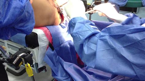 ENDOGYN Ferulizacion de cuello uterino con sonda de Foley ...