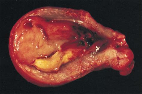Endometrial cancer | Australia| PDF | PPT| Case Reports ...