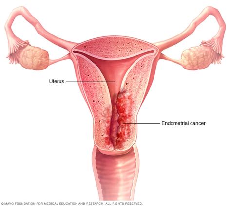 Endometrial cancer   Symptoms and causes   Mayo Clinic