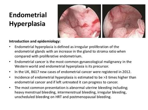 Endometrial Hyperplasia