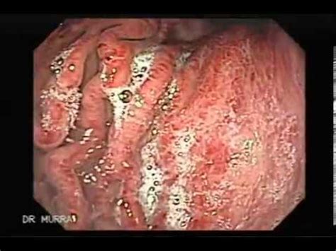 Endoscopia de Gastritis Aguda Severa   YouTube