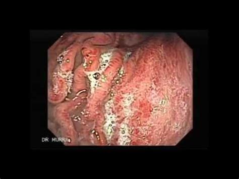 Endoscopia de Gastritis Aguda Severa   YouTube