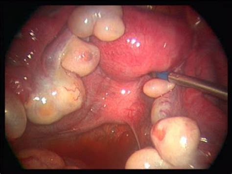 Endoscopia Ginecologica: Ovarios en Rosario