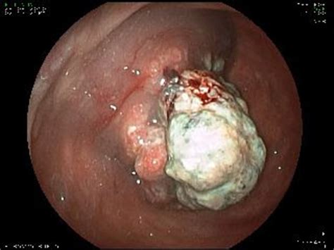 Endoscopia y Cirugía Digestiva: NEOPLASIA DE RECTO INFERIOR