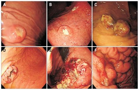 Endoscopic appearance of metastatic tumors in the stoma ...