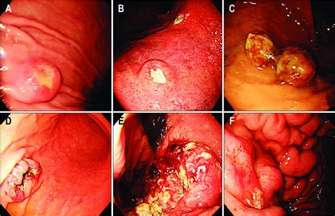 Endoscopic appearance of metastatic tumors in the stomach ...