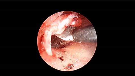 Endoscopic Ear Canal Lesion_Dr Nirmal Patel_Sydney ...