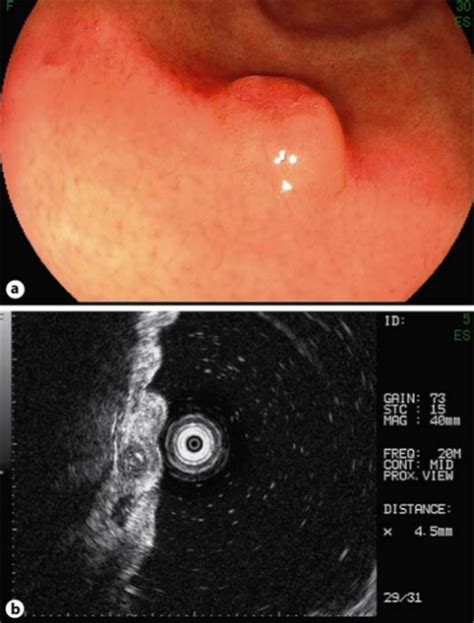 Endoscopic view of gastric metastasis of breast cancer ...