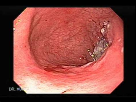 Endoscopy of an Advanced Gastric Cancer   YouTube