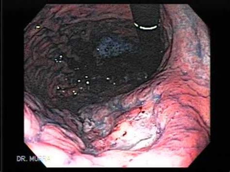 Endoscopy Ulcerated Gastric Cancer   YouTube