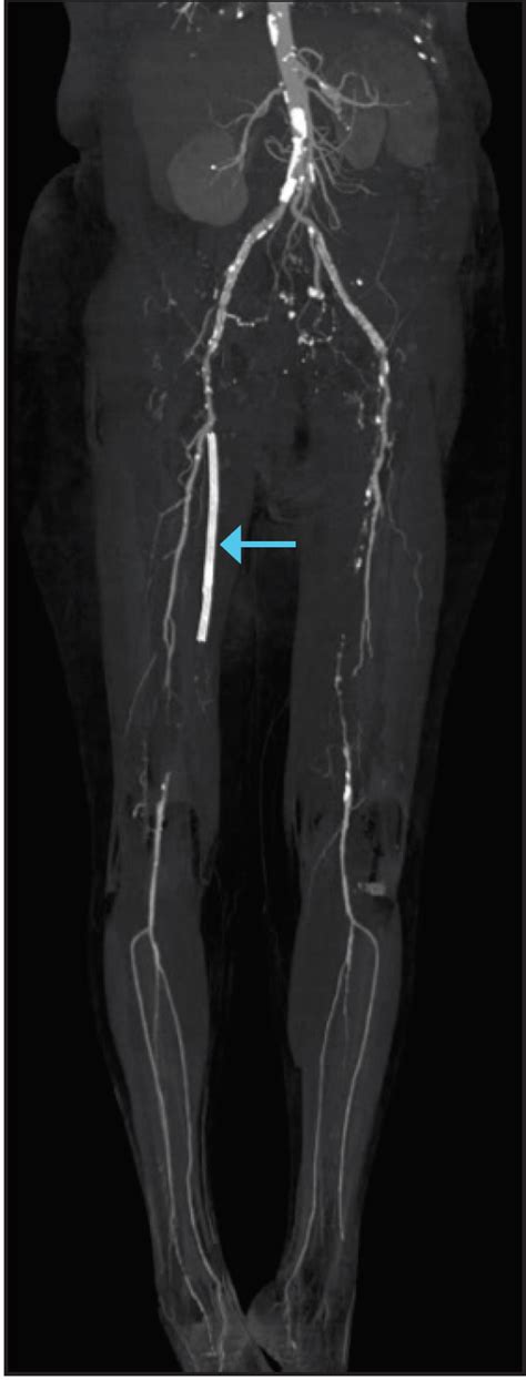 Endovascular Today   CT Reconstruction in Critical Limb ...