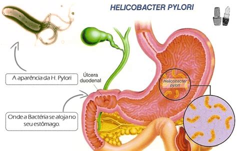 ENFERMAGEM: Helicobacter pylori  Hp