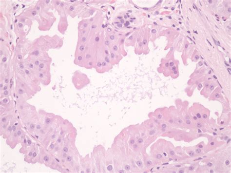 Enfermedad Fibroquística de la mama  metaplasia apocrina  | Flickr