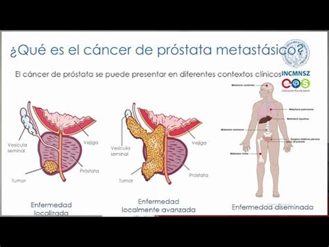 Enfermedad Metastásica por Cáncer de Próstata   INCMNSZ   Educación ...