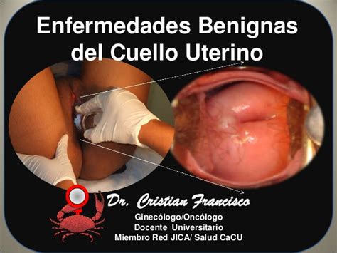 Enfermedades Benignas del Cuello Uterino Oct 2013